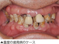 重度の歯周病のケース